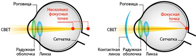 Коррекция зрения линзами